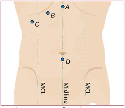 Analysis of Laparoscopic Ultrathin Choledochoscope Curative Effect on Common Bile Duct Exploration and Choledocholithotomy in 47 Cases